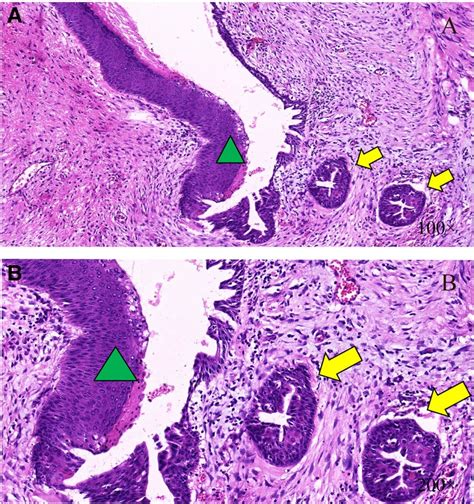 Breast Implant Associated Squamous Cell Carcinoma In A Male Patient A