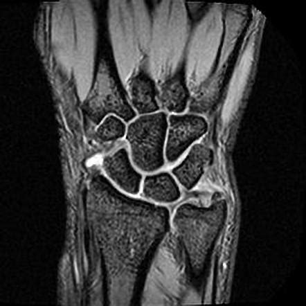 Ulnar Styloid Fracture Splint