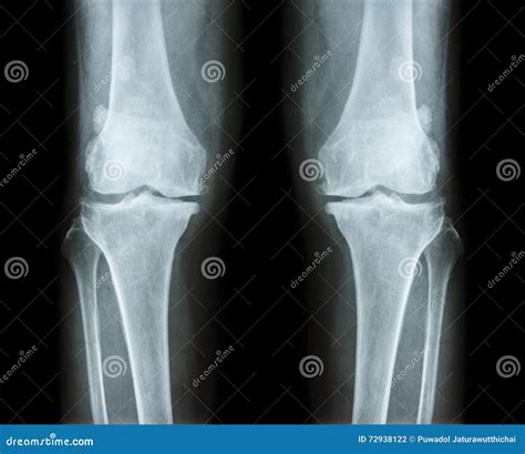 Osteoarthritis Both Knee Film X Ray Ap Anterior Posterior Of Knee Show Narrow Joint Space