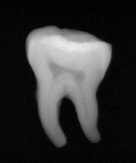 X-ray of the Hunas molar. Roots development completed, absence of ...