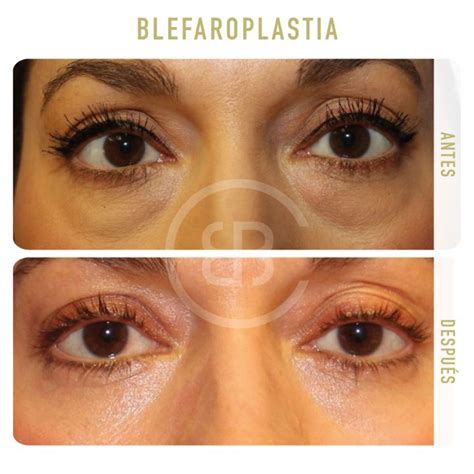 Blefaroplastia O Cirug A De P Rpados En Barcelona Mallorca Y Girona