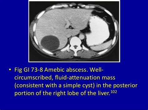 73 Focal Decreased Attenuation Masses In The Liver