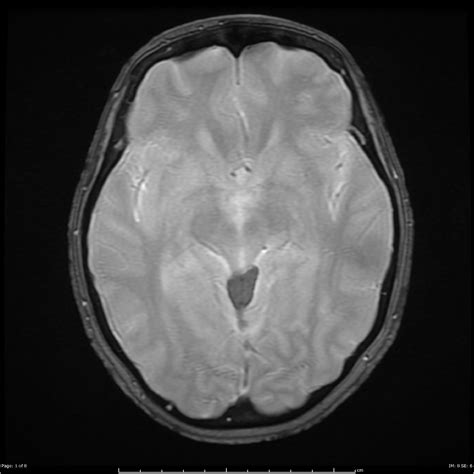 Quadrigeminal Plate Cistern Lipoma Image