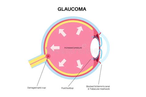 Glaucoma eye pressure stock illustration. Illustration of cornea ...