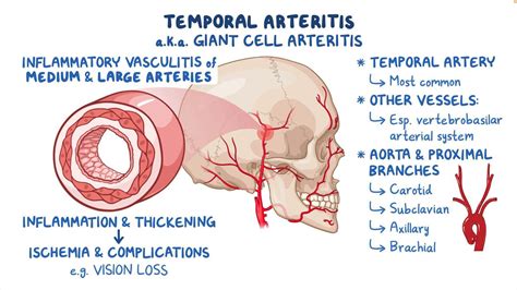 Temporal arteritis: Video & Meaning | Osmosis 