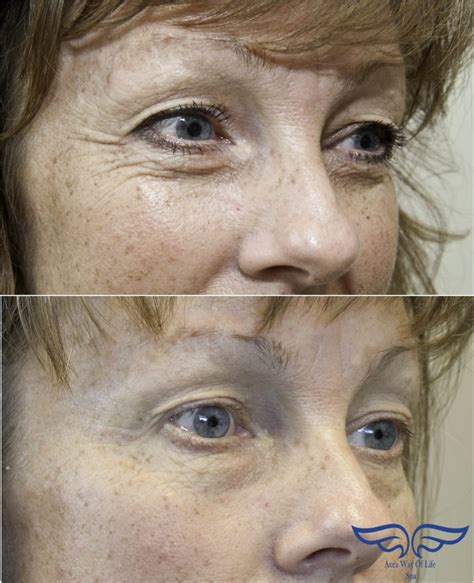 Exilis Before And After Face Body Skin Tightening Aura Way Of Life