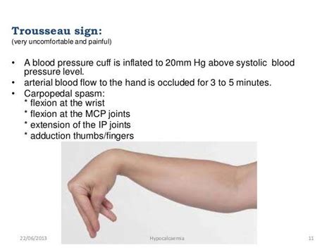 Trousseau Sign | Nursing mnemonics, Medical school essentials, Nursing ...