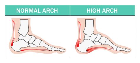 High Arches And Heel Pain Dubai Podiatry Centre