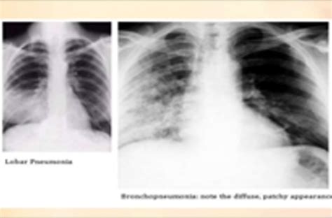 Aspiration Pneumonia