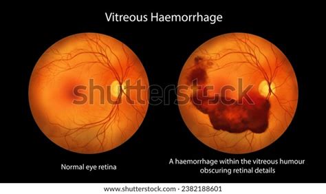 130 Vitreous Hemorrhage Images, Stock Photos, 3D objects, & Vectors ...