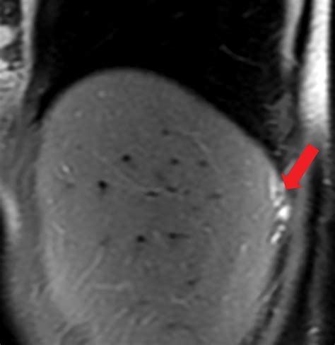 Atypical Sites Of Deeply Infiltrative Endometriosis Clinical Characteristics And Imaging