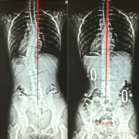 S型脊柱侧弯一定要戴长支具矫形吗此文告知您 知乎