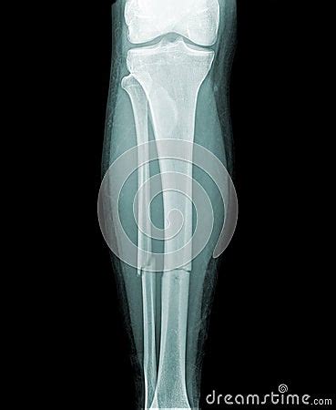 Complete Fracture Of The Lower Leg Royalty-Free Stock Image | CartoonDealer.com #13362448