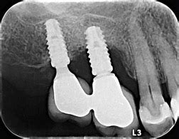 Terapia Cir Rgica No Tratamento Da Peri Implantite Plataforma Vmcom