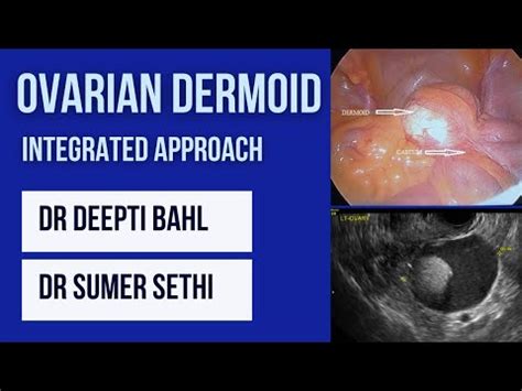 Dermoid Cyst Ovary- Clinicoradiological Approach - Sumer's Radiology Blog