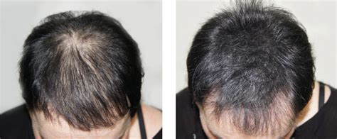 How Does Vitamin C For Hair Loss Work Dermimatch Hair Clinic Scalp