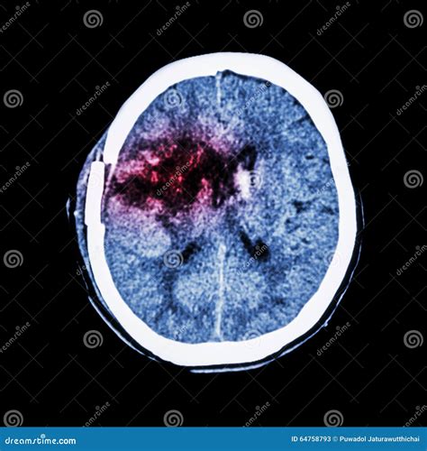 CT Scan Hemorrhagic Stroke Stock Image | CartoonDealer.com #129020227