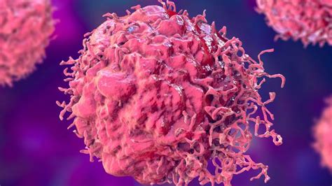 Combination Radiation With Immunotherapy Shows Promise Against “cold” Breast Cancer Tumors