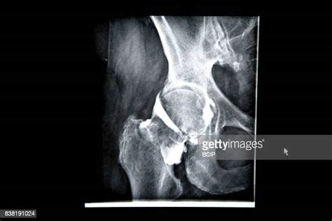 Hip Arthritis X Ray Photos and Premium High Res Pictures - Getty Images