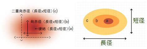 ツベルクリン判定｜大阪大学大学院医学系研究科 呼吸器・免疫内科学