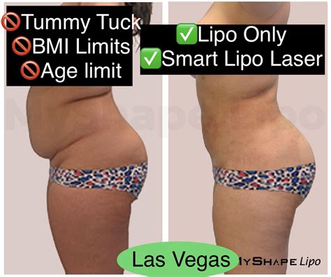 360 Lipo Is Transformative In Gaining Self Confidence Liposuction 360 And Myshape Lipo