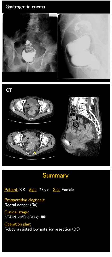 第4回 ロボット支援下低位前方切除術（robot Assisted Low Anterior Resection）｜ms Bermanの英語