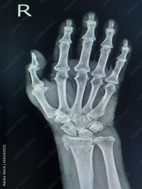 Film X Ray Wrist Ap View Old Fracture Distal Radius Stock Photo