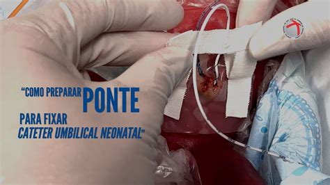 TUTORIAL COMO PREPARAR E FAZER FIXAÇÃO EM CATETER UMBILICAL NEONATAL