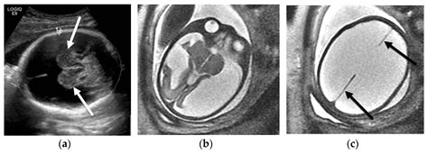 Hydranencephaly Mri