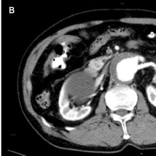 Preoperative Abdominal Computed Tomography Ct Angiography Scan