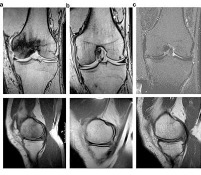 Access studies of hyperbaric oxygen therapy in the treatment of aseptic ...