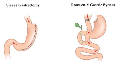 Ijerph Free Full Text Review Sex Specific Aspects In The Bariatric