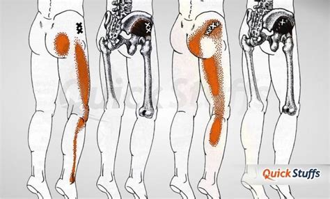 How To Massage Sciatica Trigger Points? | Quick Stuffs