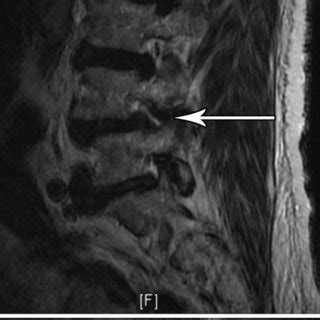 An Year Old Male With Low Back Pain And Right L Radicular Symptoms