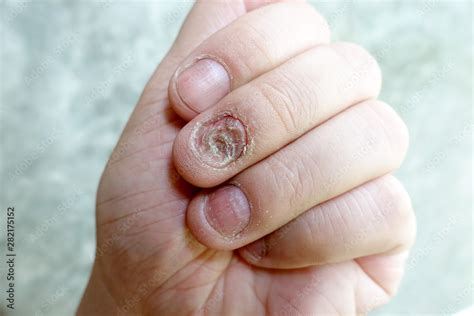 Fungal Nail Infection Dermatology Jama The Jama Network The Best Porn