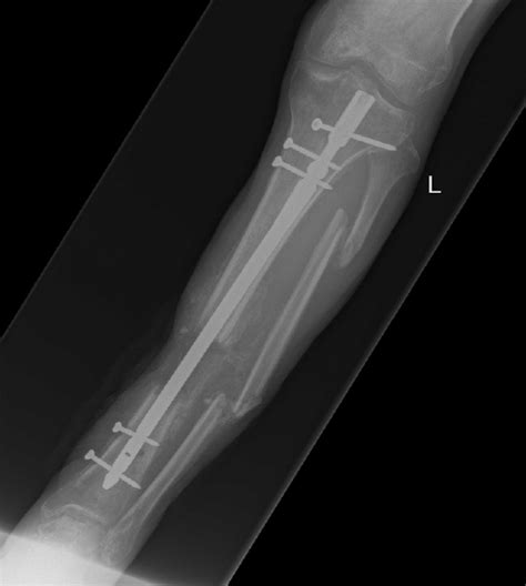 Tibia/fibula X-ray (AP), showing intramedullary nail inserted to... | Download Scientific Diagram