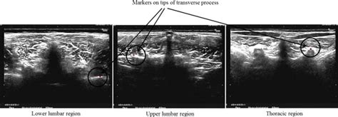 Markers at the tip of transverse processes at various regions of the ...