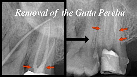 Removal Of The Gutta Percha YouTube