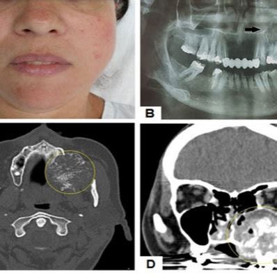 Clinical And Radiological Characteristics Of The Tumor A Extraoral