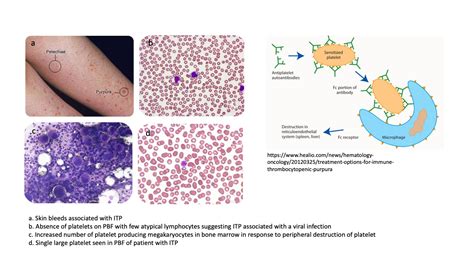 Immune thrombocytopenia purpura (ITP) – Blood & Water