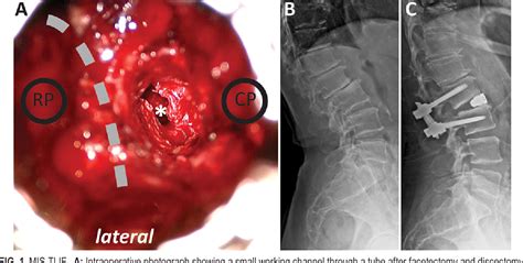 Figure 1 From Minimally Invasive Transforaminal Lumbar Interbody Fusion With Expandable Versus