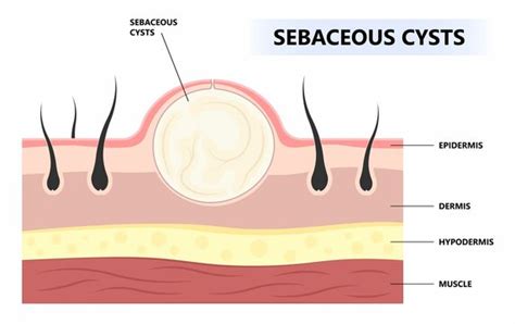 Sebaceous Cysts What Is A Sebaceous Cyst Michele Green 59 Off