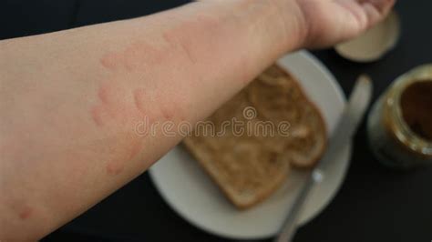 Peanut Allergy Rash Stock Photos - Free & Royalty-Free Stock Photos ...