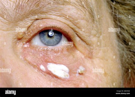 Ein Foto Zeigt Die Entwicklung Der Xanthelasma Palpebra Eine Häufige