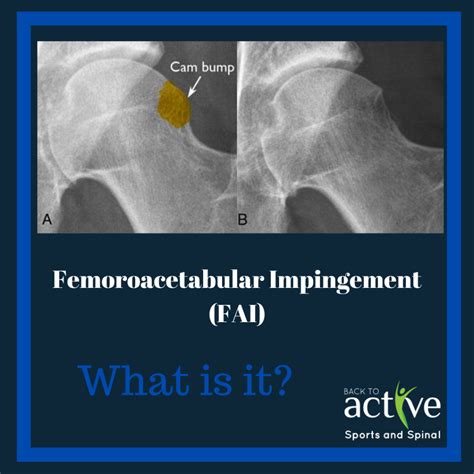 Fai Femoroacetabular Impingement