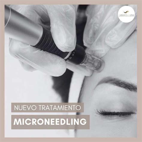 Nuevo Tratamiento Microneedling Cl Nica Carrasco Mataix Sevilla