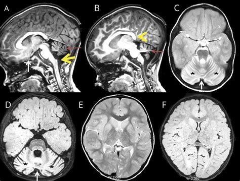 Teaching Neuroimages Beaking In The Brainstem Neurology