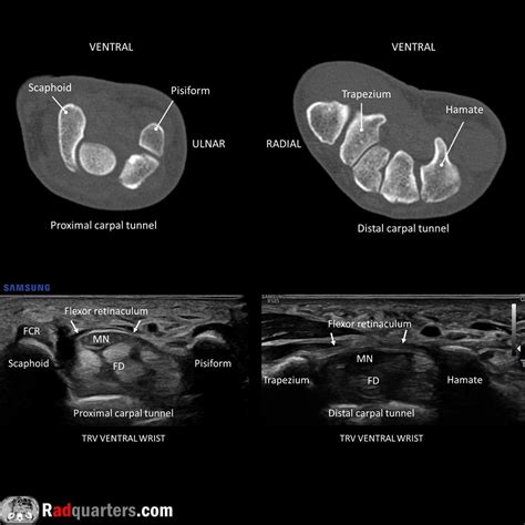 CT & ultrasound anatomy of the carpal tunnel : r/Radiology