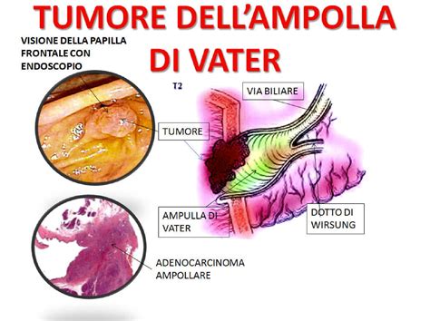 Neoplasia Maligna Dell Ampolla Di Vater