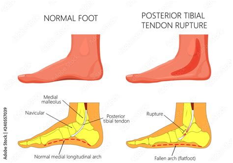 Vector illustration of healthy human foot and a medial ankle injury. Posterior tibial tendon ...